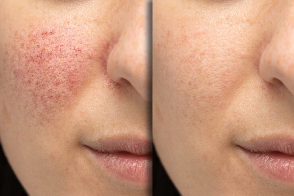 Before And After Skin